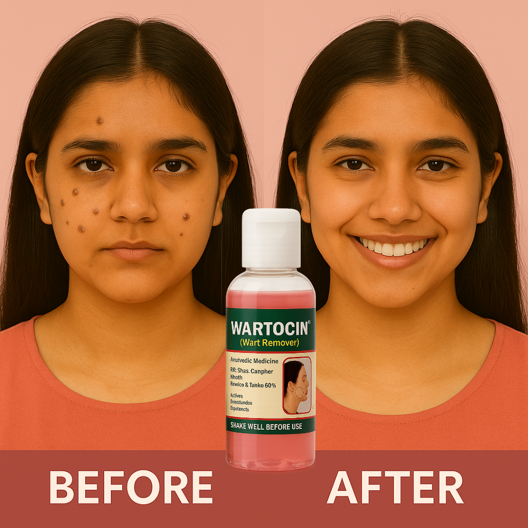 Wartocin Wart & Skin Tag Remover - 30ml