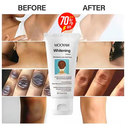 Nigricans Whitening Cream for Knee, Elbow, Neck, Underarm