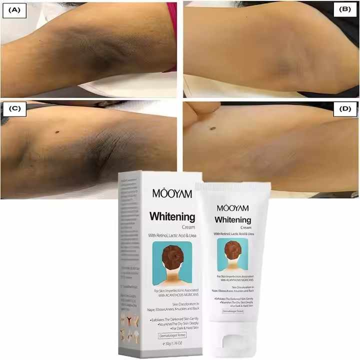 Nigricans Whitening Cream for Knee, Elbow, Neck, Underarm