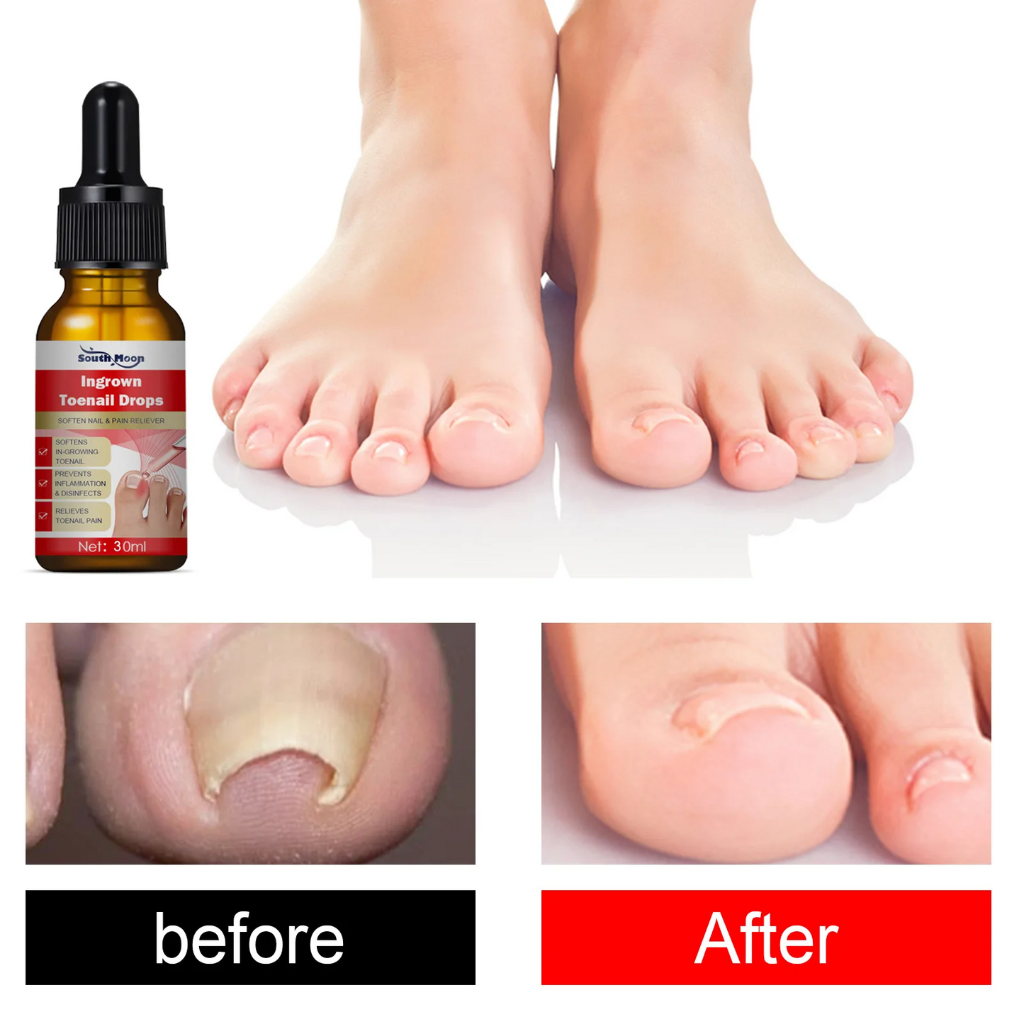 Southmoon Ingrown Toenail Drops Nail Repair Oil (BUY 1 GET 1 FREE🔥🔥)