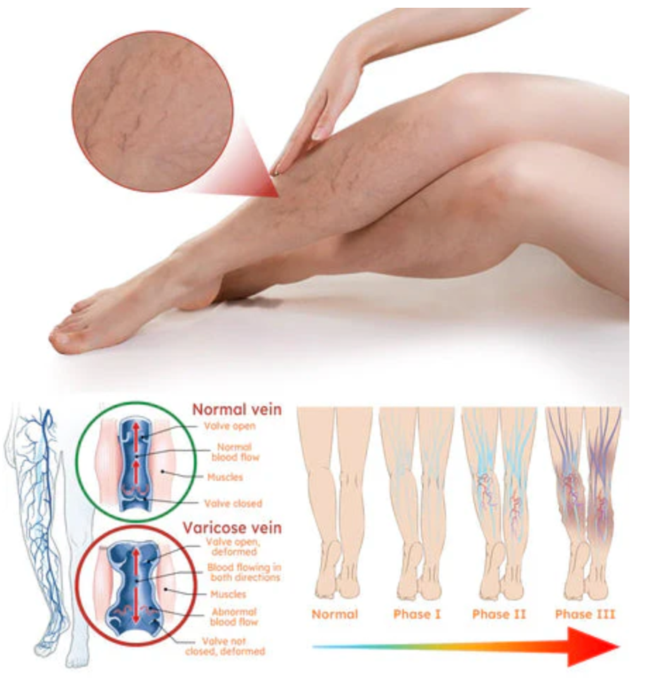 Turmeric Varicose Veins Relief Spray - (Buy 1 Get 1 FREE🔥🔥)