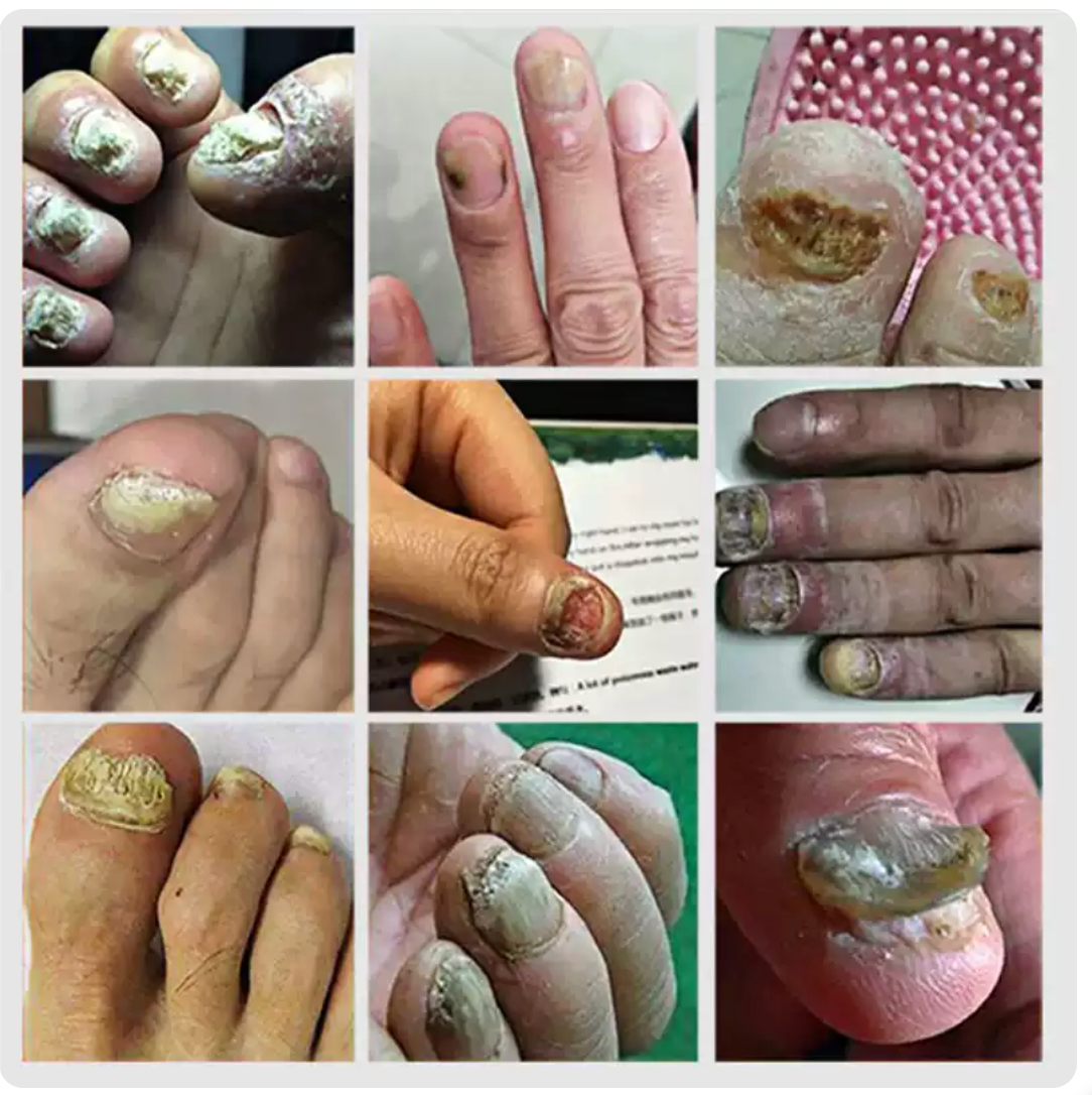 Southmoon Ingrown Toenail Drops Nail Repair Oil (BUY 1 GET 1 FREE🔥🔥)