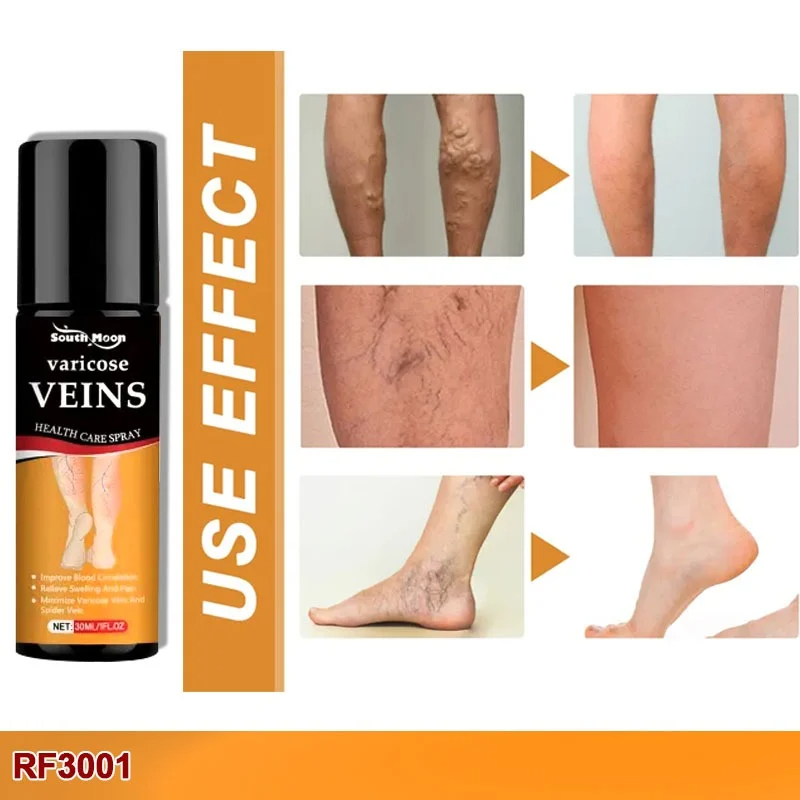 Turmeric Varicose Veins Relief Spray - (Buy 1 Get 1 FREE🔥🔥)