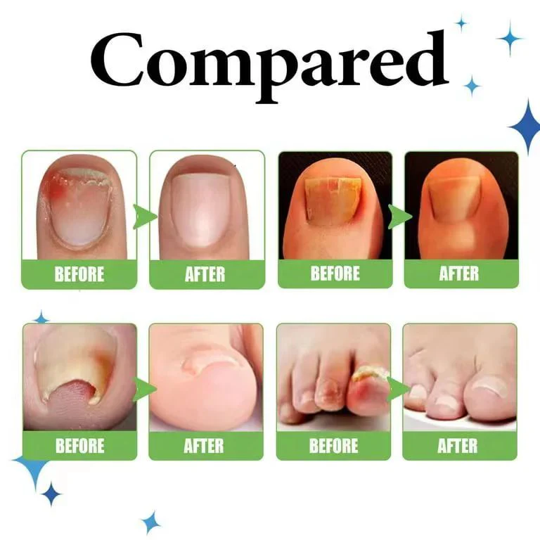 Anti Paronychia Relief Oil - (Buy 1 Get 1 FREE🔥🔥)