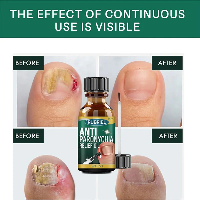 Anti Paronychia Relief Oil - (Buy 1 Get 1 FREE🔥🔥)