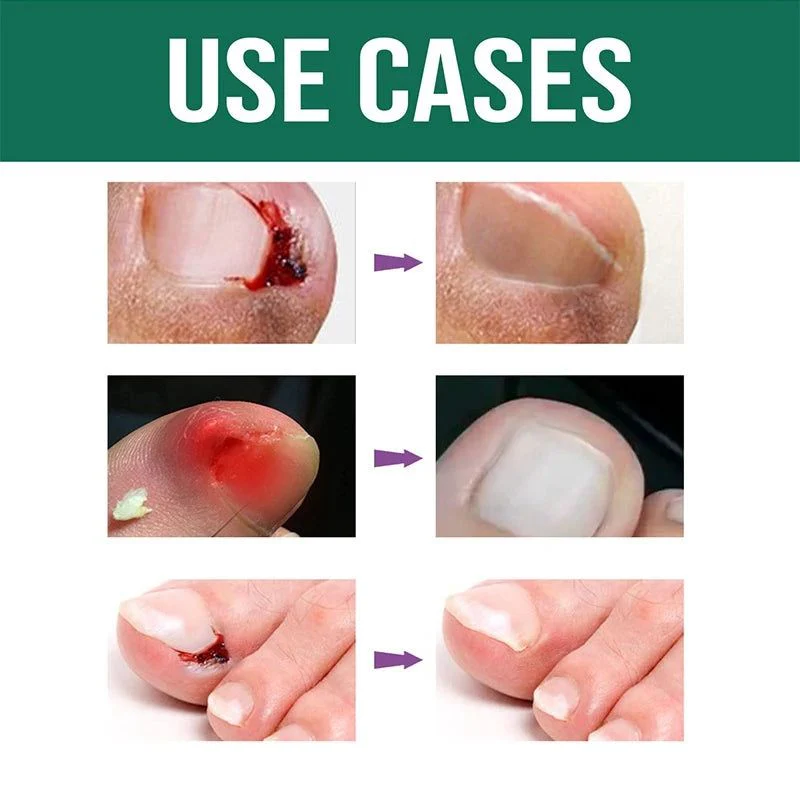 Anti Paronychia Relief Oil - (Buy 1 Get 1 FREE🔥🔥)